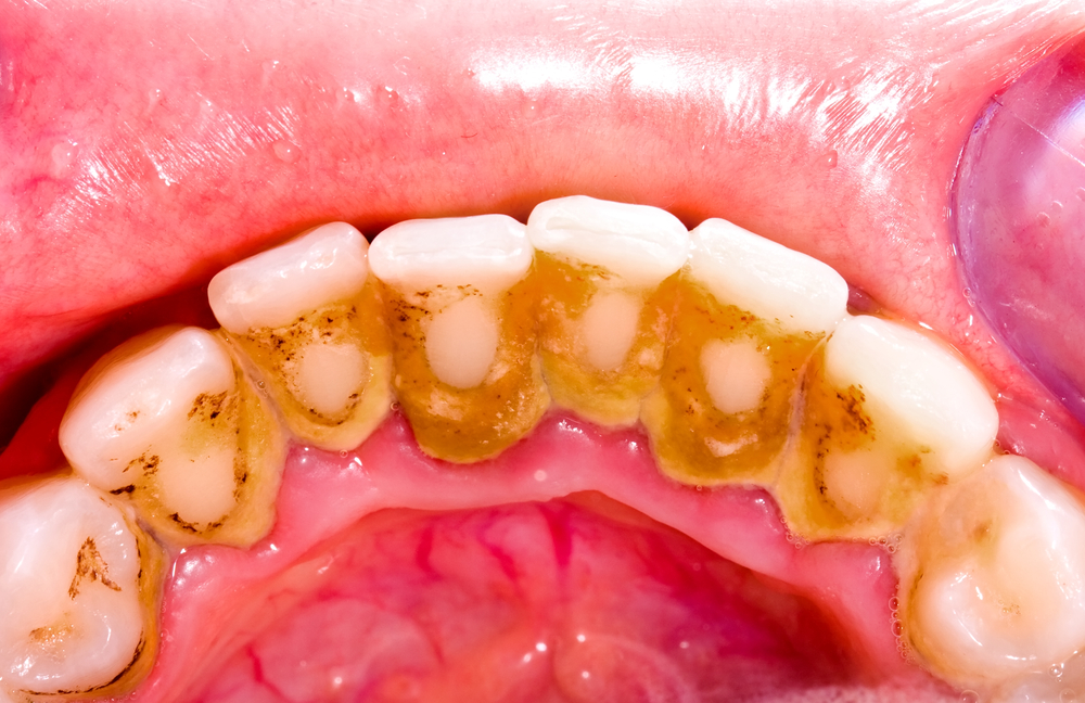 Unhealthy,Denture,,Tartar,On,Frontal,Teeth