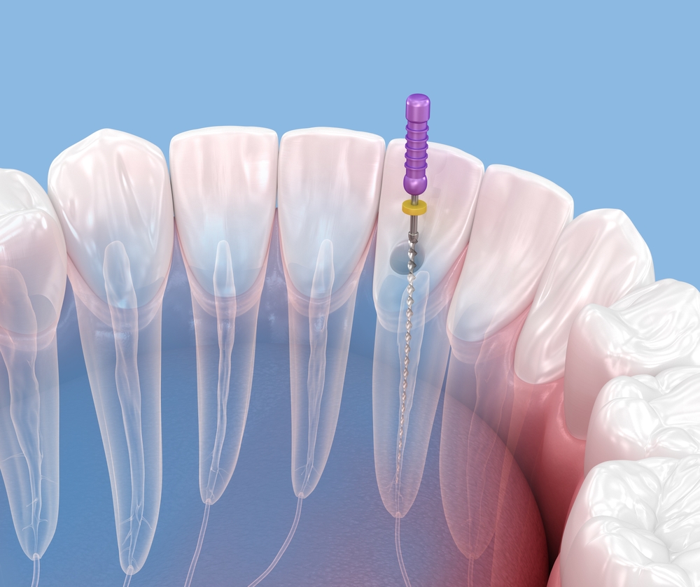Endodontic,Root,Canal,Treatment,Process.,Medically,Accurate,Tooth,3d,Illustration.