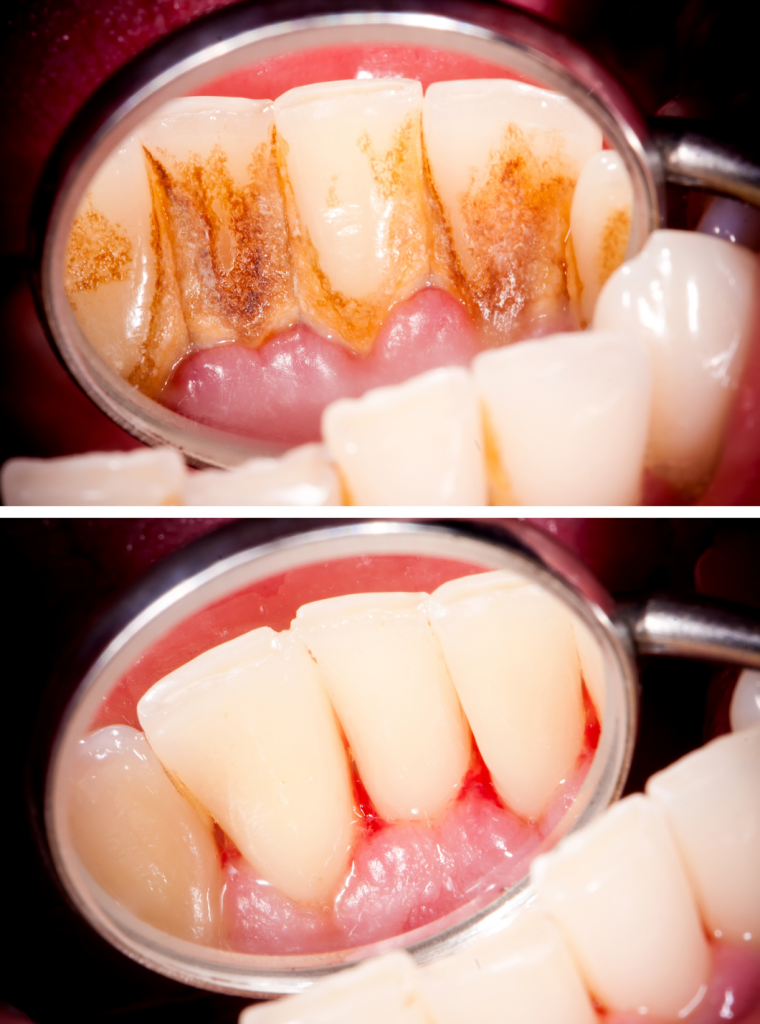 Periodontit-