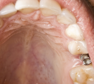implantat4